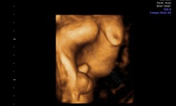 Echographie 3d sexe masculin