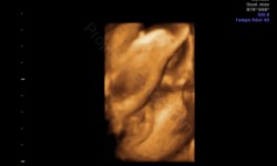 Echographie 3D sexe feminin