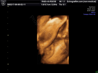 Determination Du Sexe De Bebe A 100 Des 14 Semaines Echografilm Echographie 3d Paris