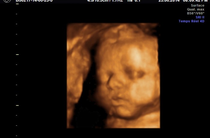 échographie 3d à 31 semaines de grossesse