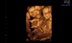 Échographie 3D de grossesse gémellaire à 14 semaines de gestation