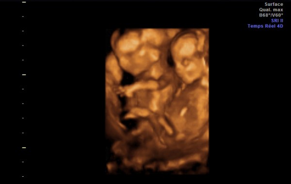 Échographie 3D de grossesse gémellaire à 14 semaines de gestation