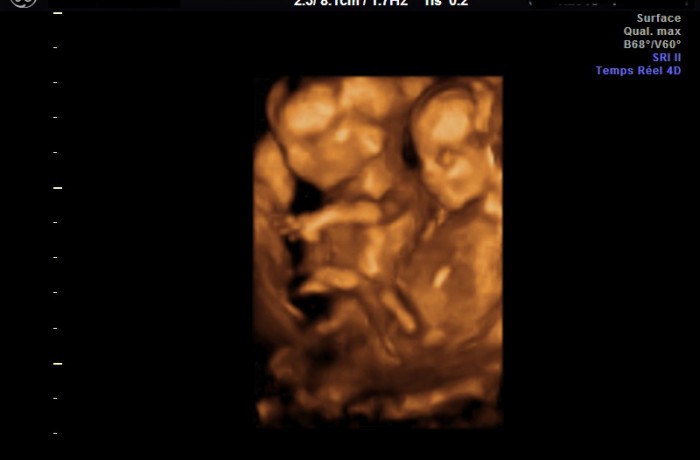 Échographie 3D de grossesse gémellaire à 14 semaines de gestation