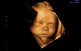 3D ultrasound: baby's mouth and nose in 3D — Echografilm Paris