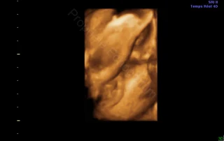 3D ultrasound: example of female sex observation — Echografilm Paris