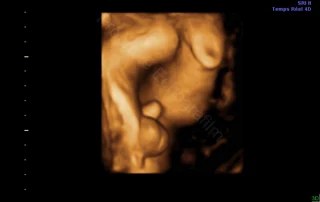 3D ultrasound: example of male sex observation — Echografilm Paris