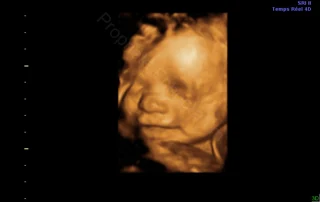 3D ultrasound: baby's facial expression — Echografilm Paris