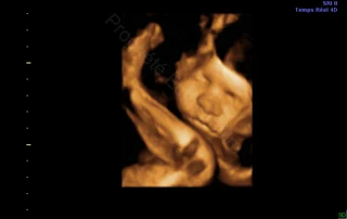 3D ultrasound: baby's leg near the wall — Echografilm Paris