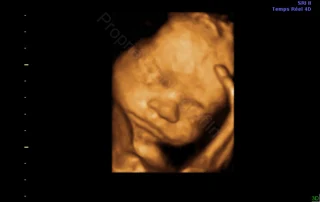 3D ultrasound: baby's leg near the forehead — Echografilm Paris