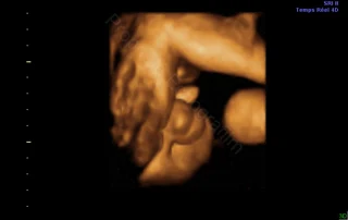 3D ultrasound: observation of the baby's sex — Echografilm Paris