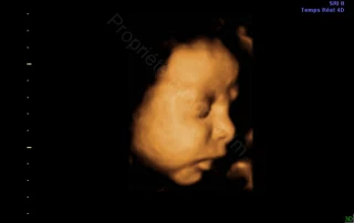 3D ultrasound: profile of the baby's face — Echografilm Paris