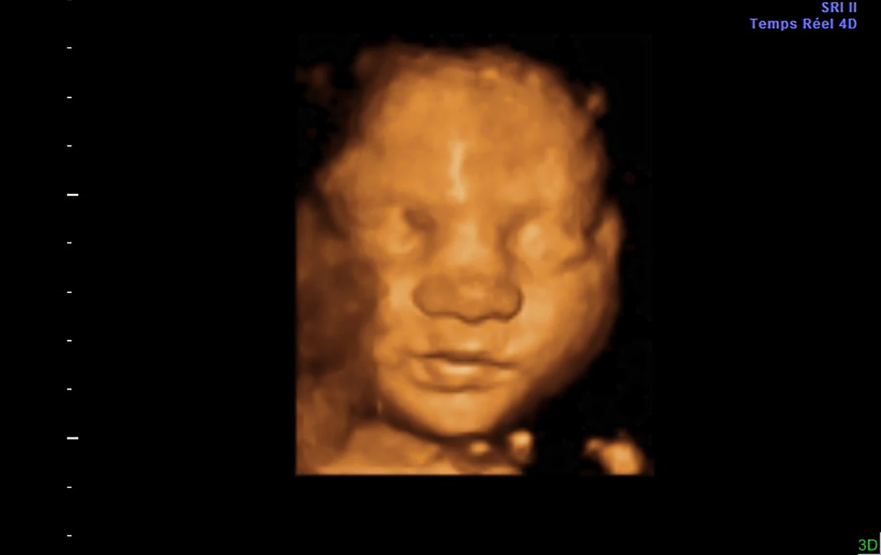 Ecografía 3D: rostro de frente con ojos cerrados — imagen 3D original