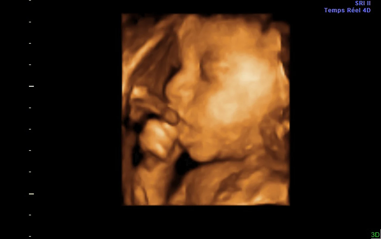 Ecografía 3D: rostro de perfil, mano cerca de la boca — imagen 3D original