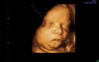 3D ultrasound: baby's face with mouth open — Echografilm Paris
