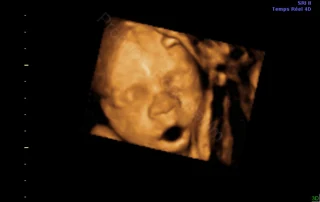 3D ultrasound: baby's face with mouth open — Echografilm Paris
