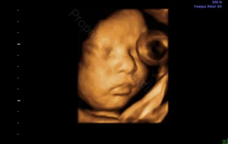 3D ultrasound: baby's face and loop of umbilical cord — Echografilm Paris