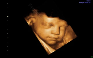 3D ultrasound: baby's face, hand near the mouth — Echografilm Paris