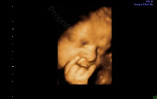 3D ultrasound: baby's face, hand near the mouth — Echografilm Paris